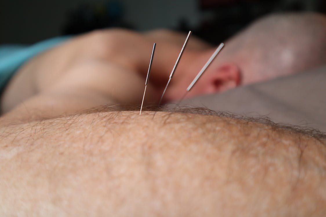 Gratis lagerfoto af akupunktur, hud, kropsbehåring Lagerfoto