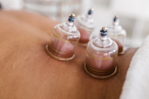 Free Close Up Shot of a Cupping Therapy Stock Photo