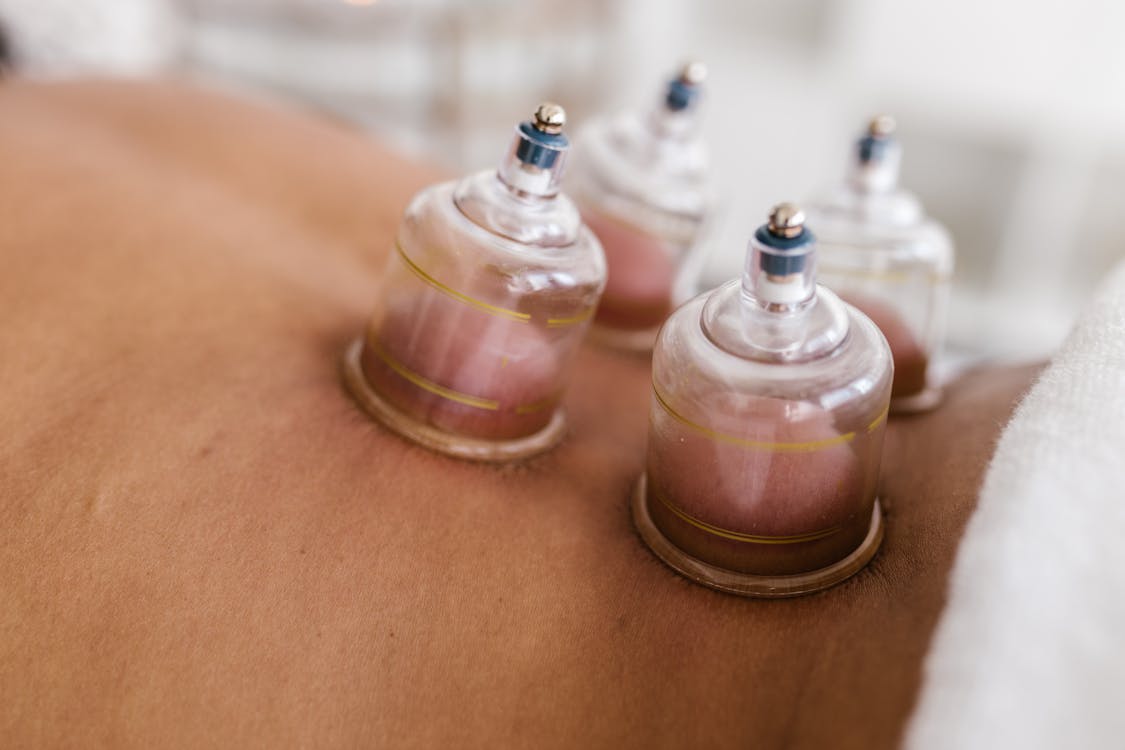 Free Close Up Shot of a Cupping Therapy Stock Photo