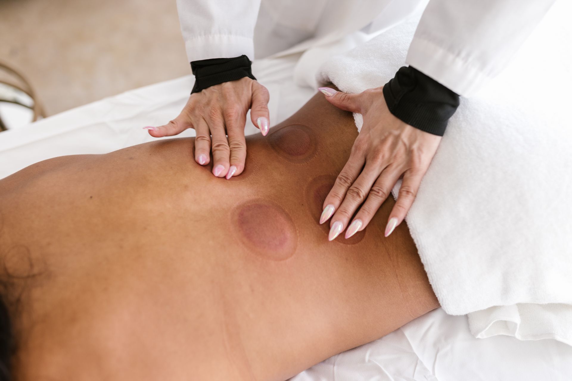 A Person Massaging a Ventosa Cup Marks on a Patient's Back