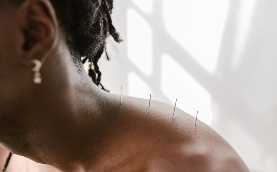 Acupuncture therapy in Mumbra with fine needles placed on a client's shoulder during a wellness session