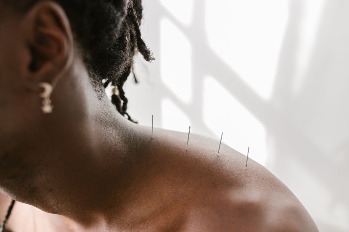 Professional dry needling therapy session focusing on muscle trigger points