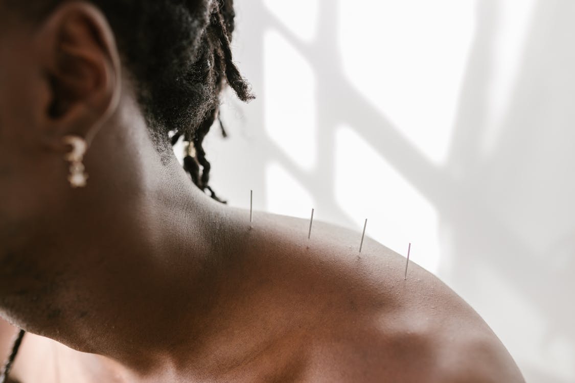 Free A Man Undergoing Acupuncture Stock Photo