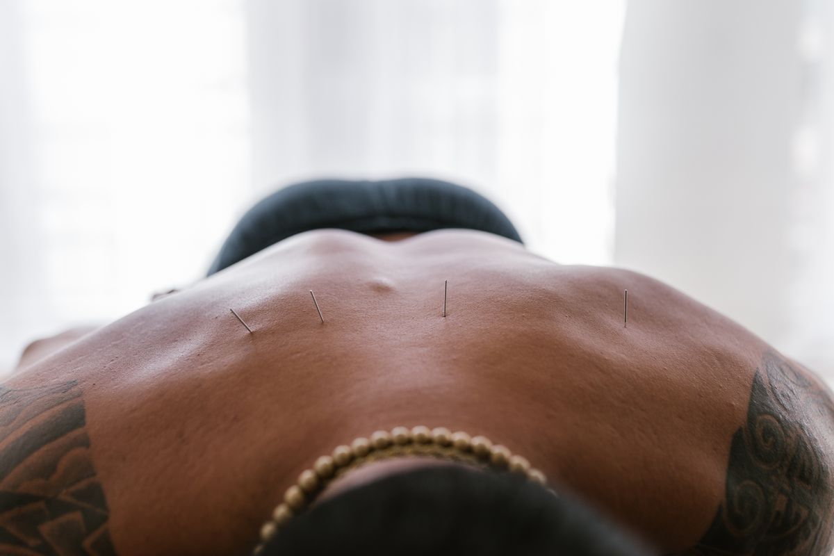 Needles in place along a patient's back during a combined warming treatment