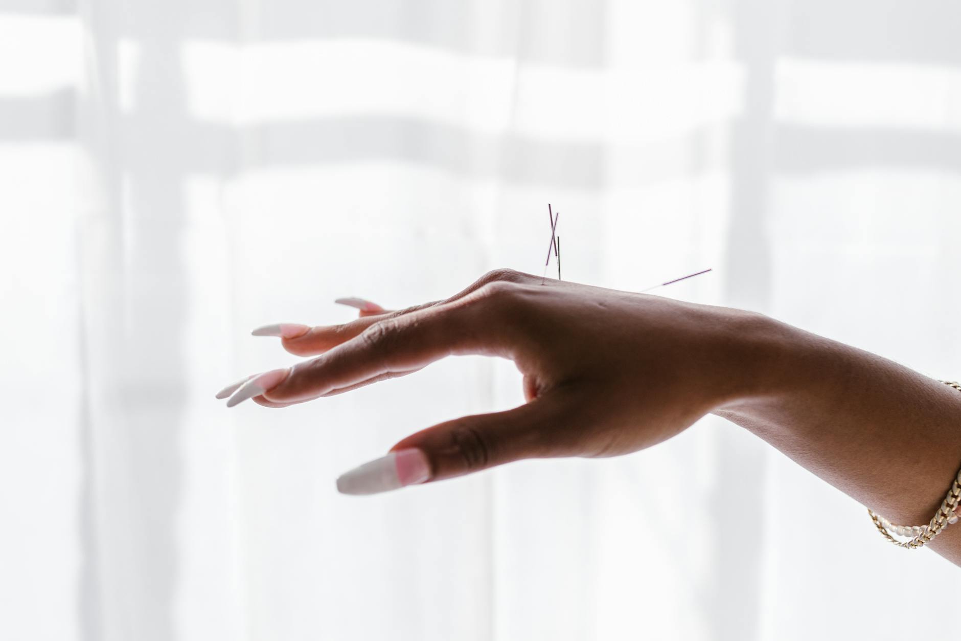 Close-up view of acupuncture needles on a woman's hand against a light background.