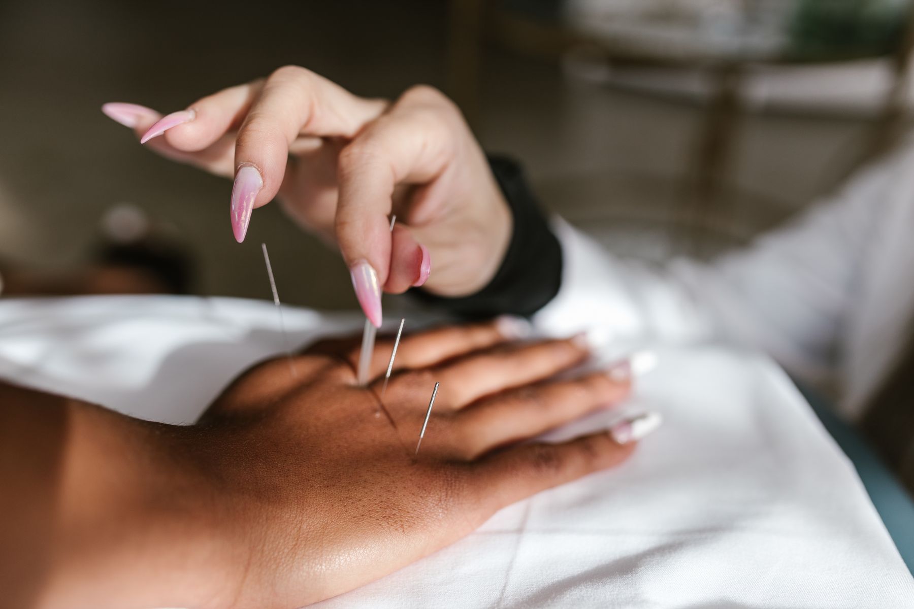 Close-up of a calm acupuncture treatment session