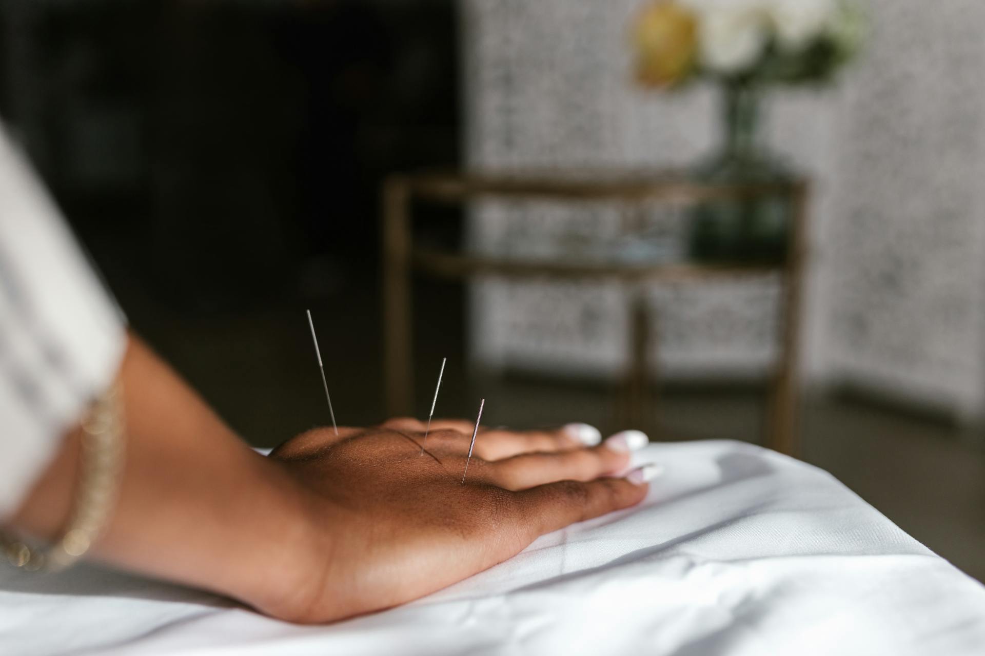 A Person Having an Acupuncture Treatment