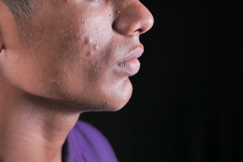 A Man with Pimples on his Cheek