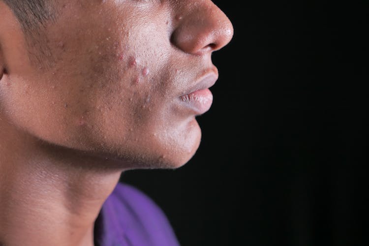 A Man With Pimples On His Cheek