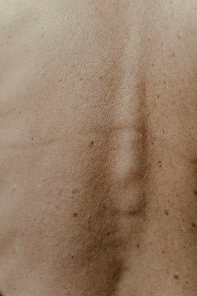 Close-up Shot Of A Person's Back With Freckles