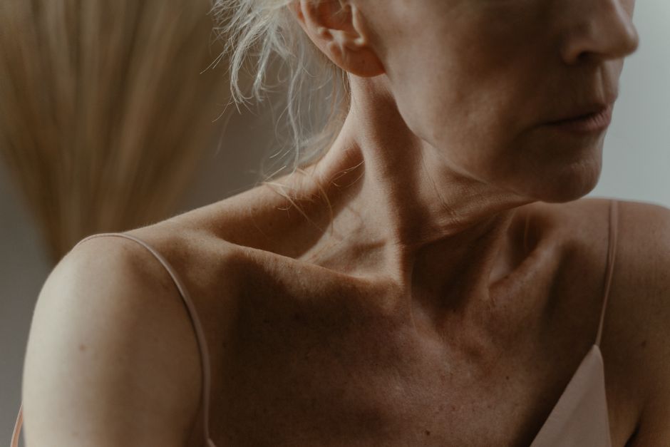 Spider Veins on Face - IPL for broken capillaries