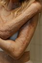 Free stock photo of body positive, burn injury, close-up