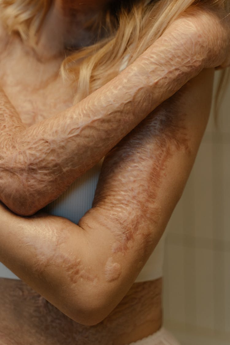 Burn Scars On A Woman's Body