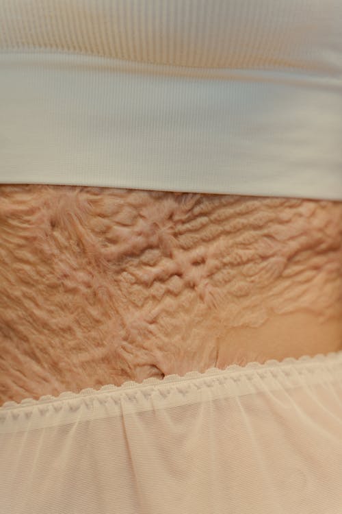 Free  A Close-Up Shot of a Person's Skin with Scars Stock Photo