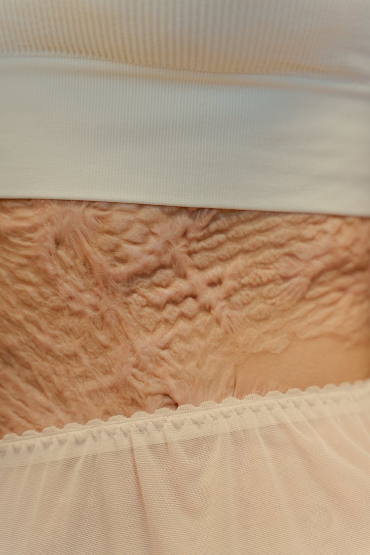  A Close-Up Shot Of A Person's Skin With Scars