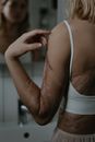 A Woman with Scars on Her Body Looking at a Mirror