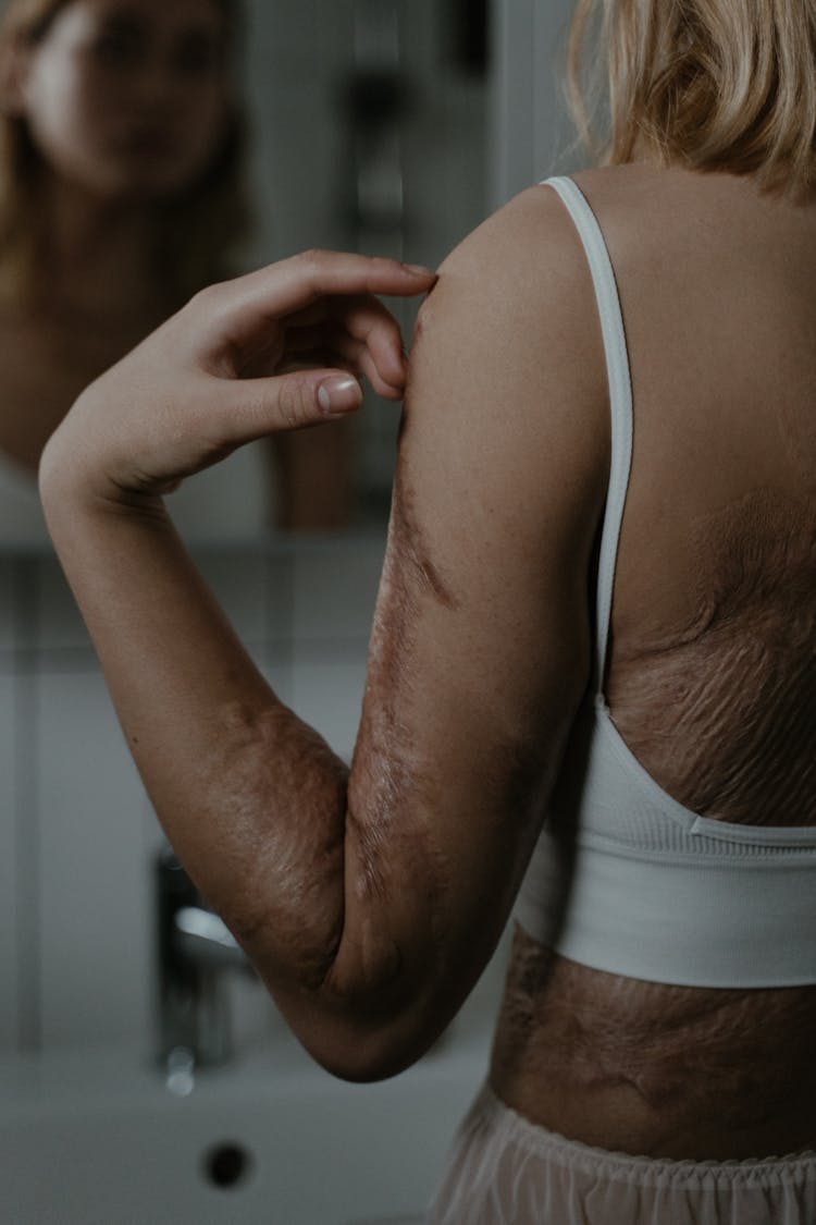 
A Woman With Scars On Her Body Looking At A Mirror