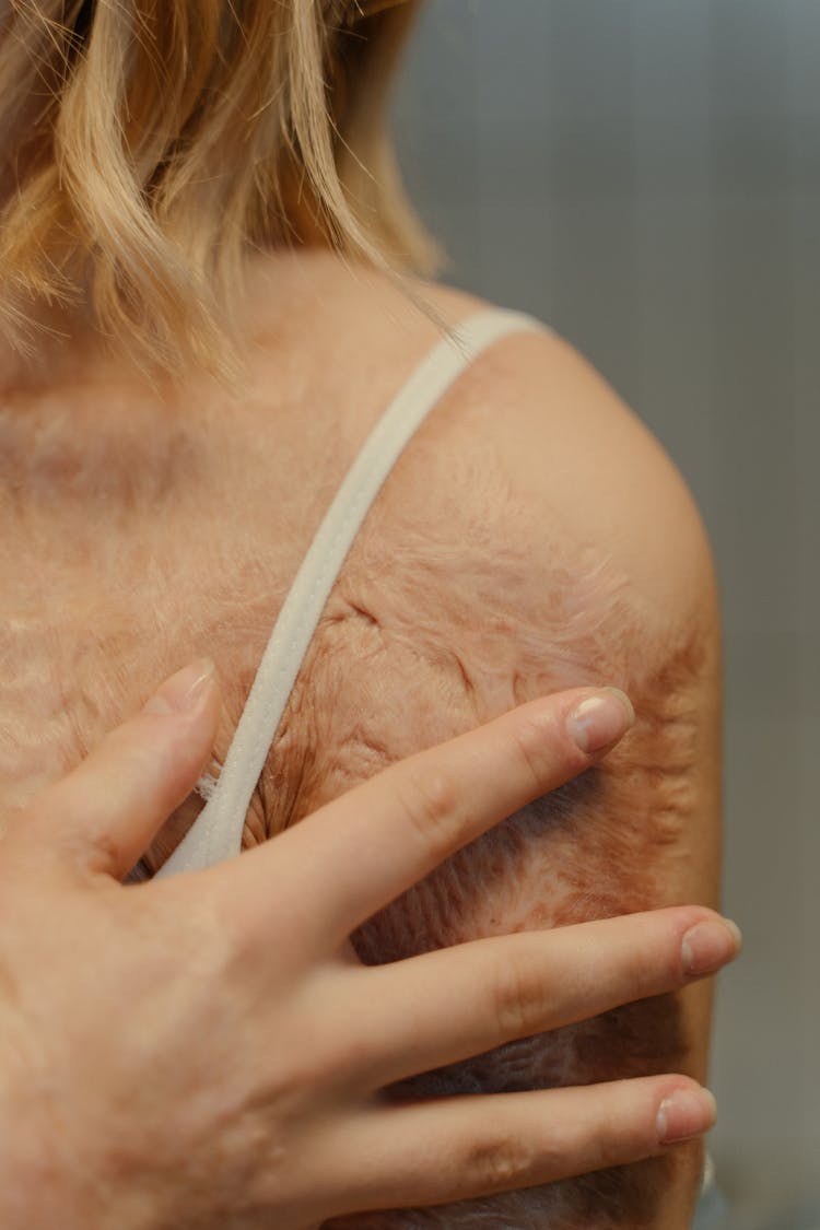 
A Close-Up Shot Of Scars On A Woman's Arm