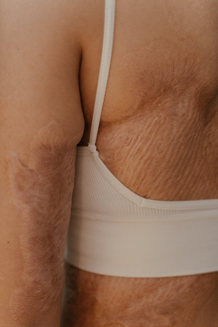 A Close-Up Shot Of A Person's Skin With Scars