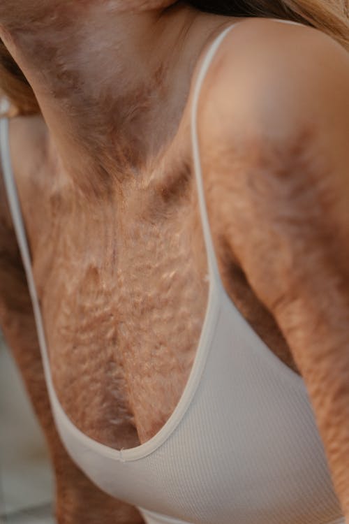 
A Close-Up Shot of a Person's Skin with Scars