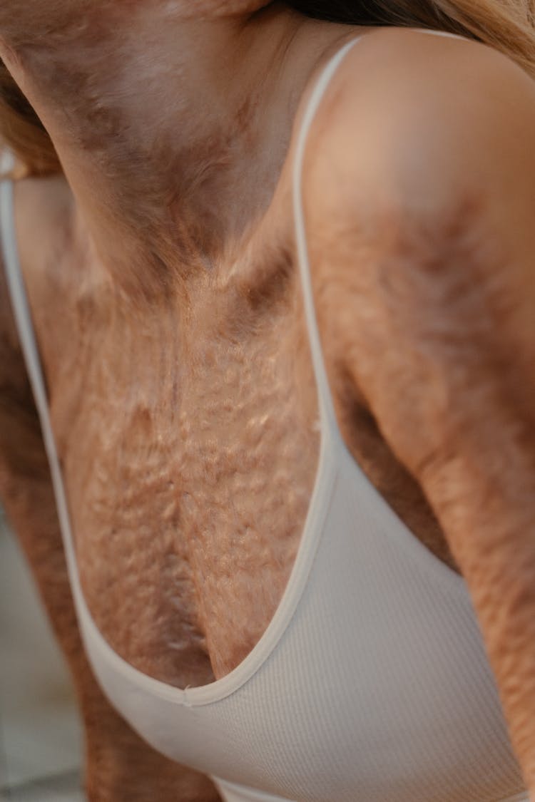 
A Close-Up Shot Of A Person's Skin With Scars