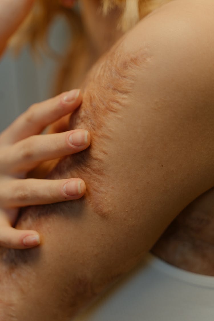 
A Close-Up Shot Of A Person's Skin With Scars