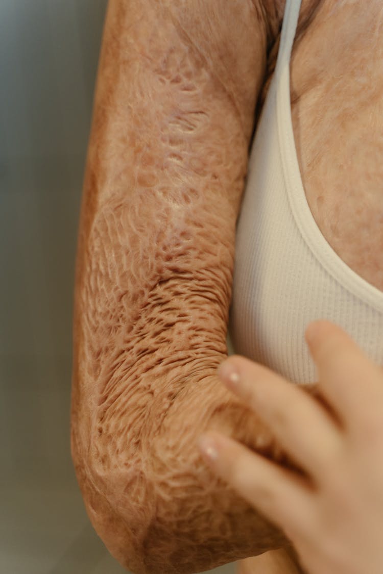 A Close-Up Shot Of A Person's Arm With Burn Scars