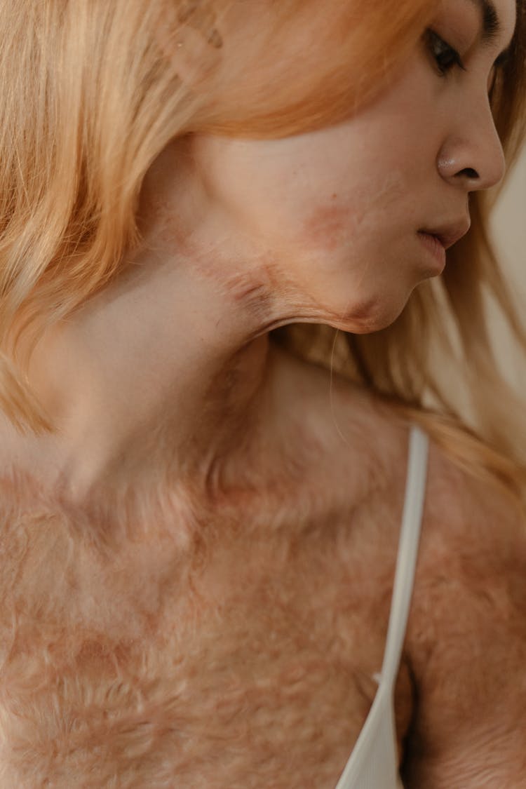 A Woman With Burn Scars