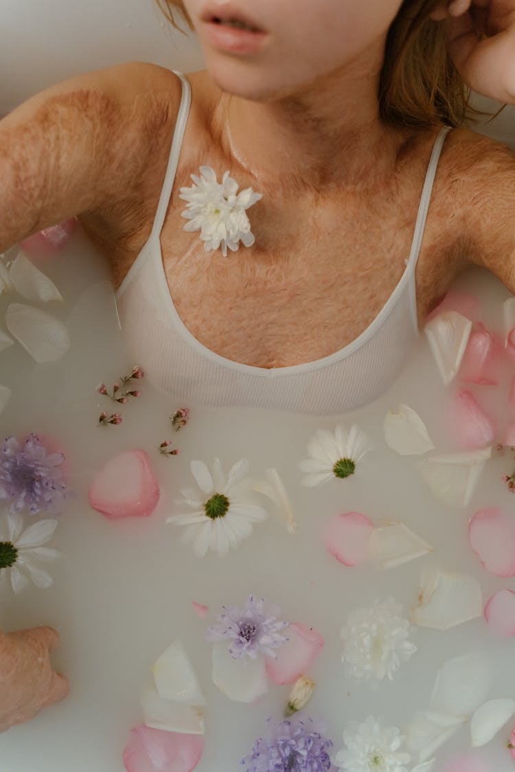 
A Woman With Burn Scars Having A Bath