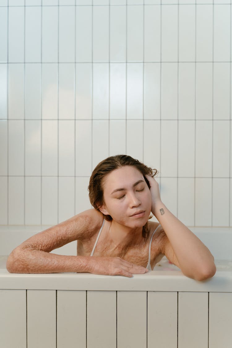 A Woman With Scars All Over Her Body Soaking On A Bath Tub