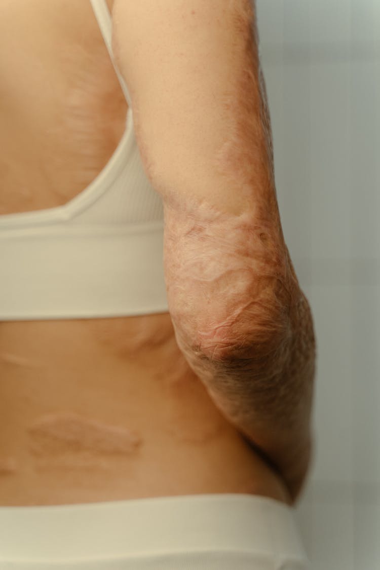 A Close-Up Shot Of A Person's Arm With Burn Scars