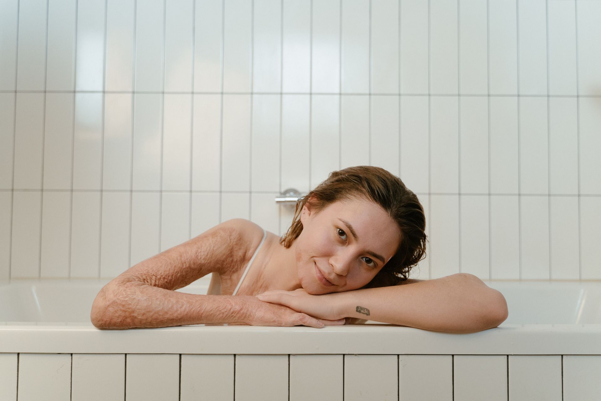 A Woman in the Bathtub with Burn Scars