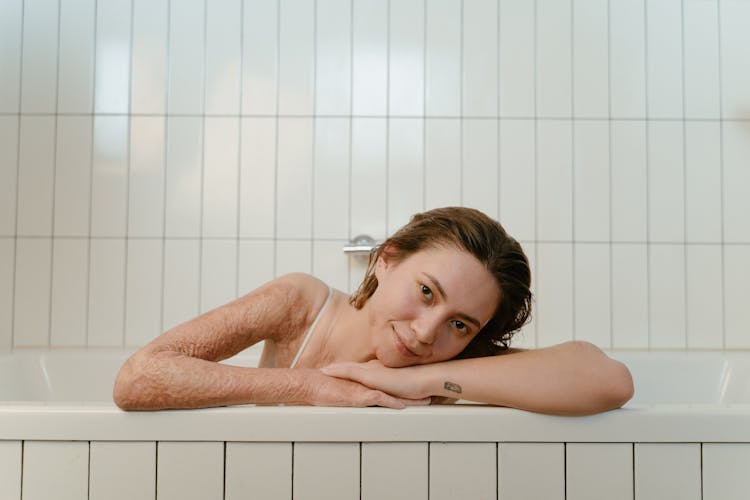 A Woman In The Bathtub With Burn Scars