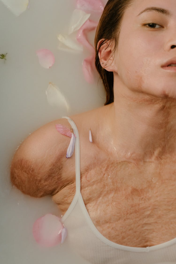 
A Woman With Burn Scars Having A Bath