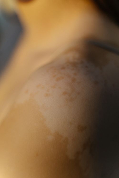 Free Intimate close-up of a person's shoulder with noticeable skin discoloration and vitiligo patches, highlighting natural beauty. Stock Photo