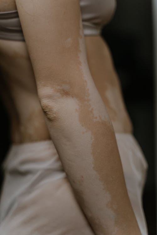 Foto d'estoc gratuïta de colze, cos positiu, decoloració de la pell