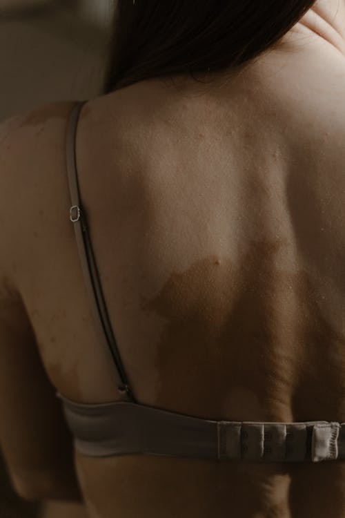 Základová fotografie zdarma na téma hypopigmentace, tělo pozitivní, vitiligo