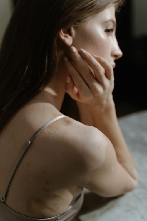 Free Elegant side profile of a woman embracing her vitiligo, highlighting beauty and self-love. Stock Photo