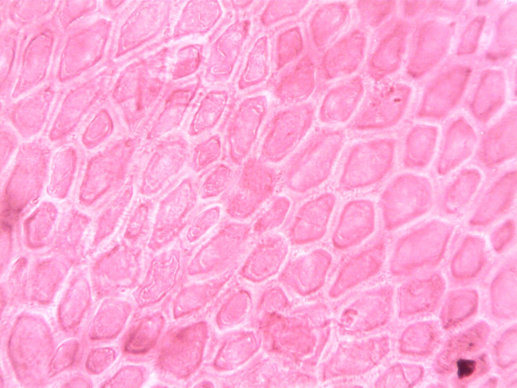 Stromal Endometriosis: Understanding This Cellular Variation of Endometriosis