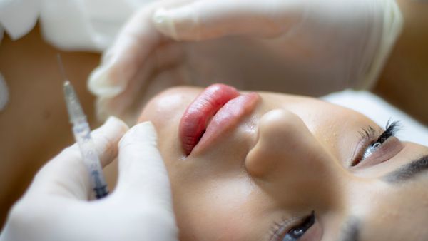 Medical procedure: Face Lift