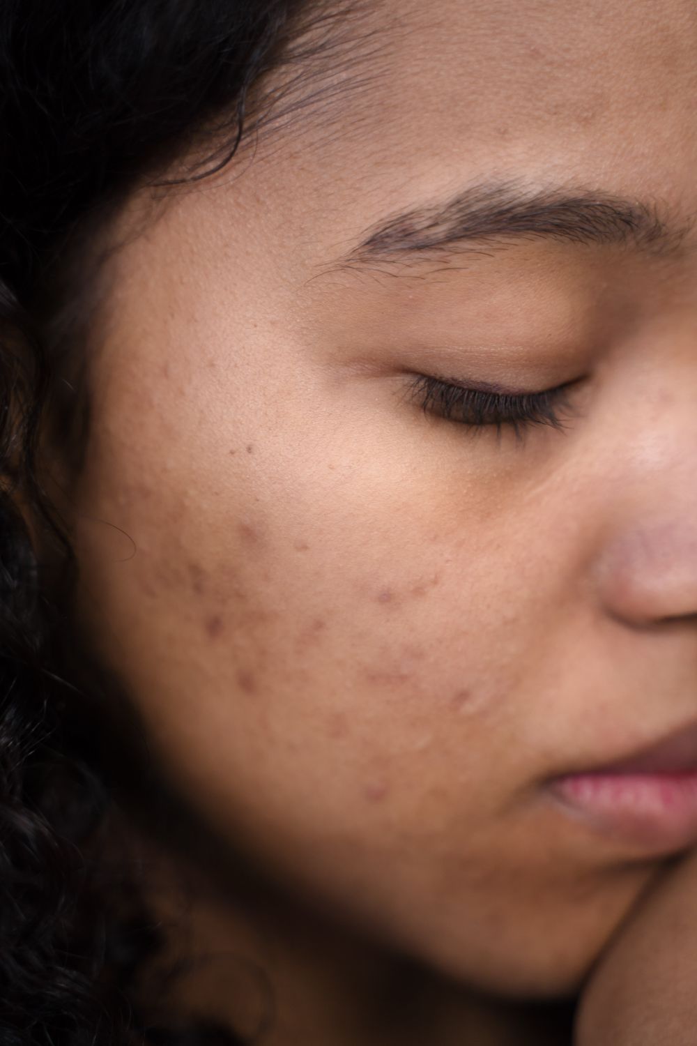 Acne-prone skin