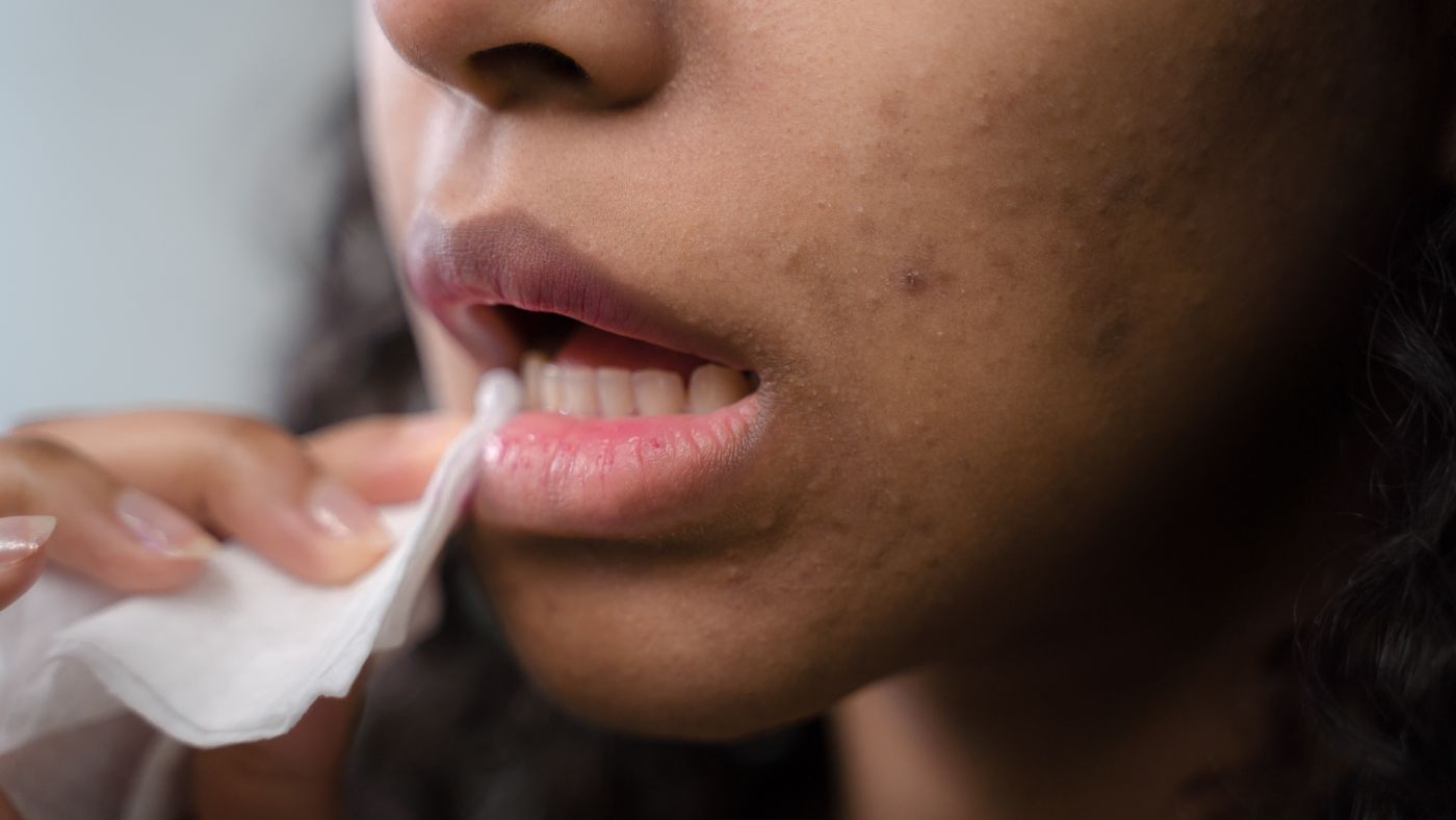 Acne Treatments: What Actually Works (and What Just Burns)