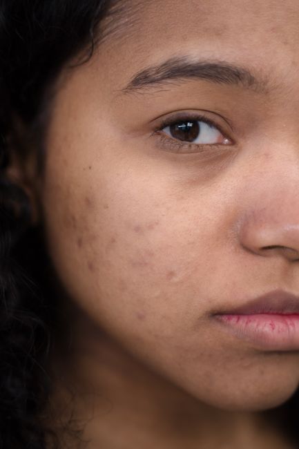 Expert Tips for Maximizing Results and Maintaining Smooth, Clear Skin