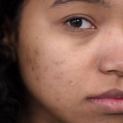 Dull Skin