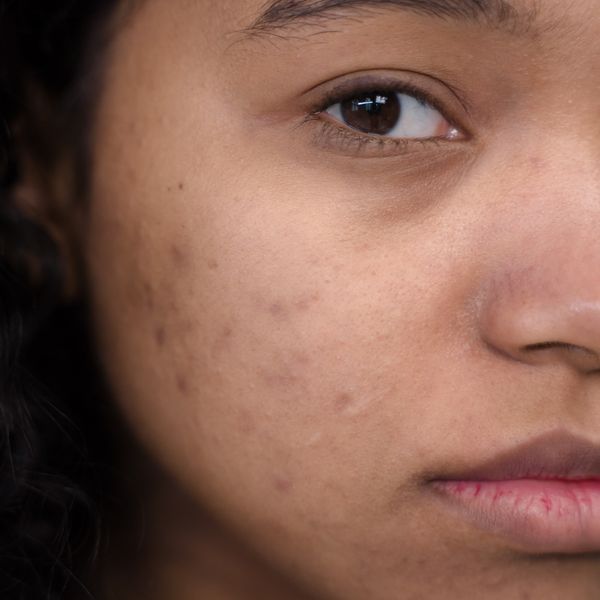 Cheek texture before treatment