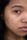 acne scars