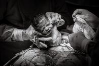 Black and white photo of childbirth
