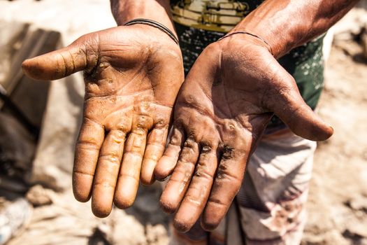 Person Showing Hands with Thick Callus