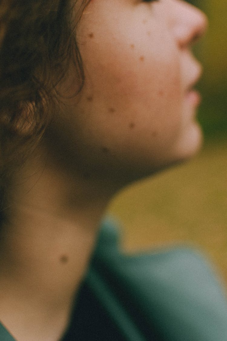 Side View Of A Woman With Moles On Her Face