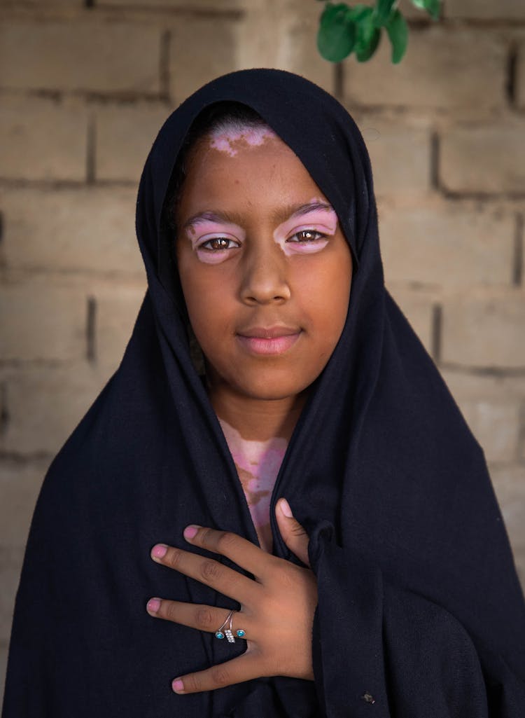 Child With Vitiligo